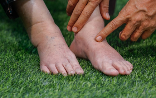 Ayaklarda ödem birikmesi
