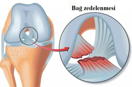 Arka çapraz bağ dokusunda yırtılma