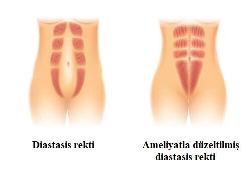 diastasis rekti