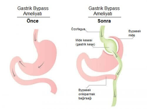 Bariatrik cerrahi gastrik bypass görseli