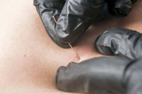 Kuru İğneleme: Bilmeniz Gereken Her Şey